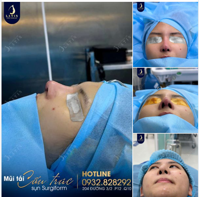 Nỗi sợ từ lần nâng mũi trước đó không thành công
