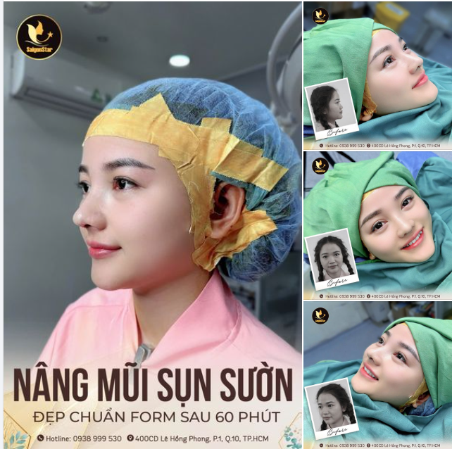 HOÀN THÀNH DÁNG MŨI CẤU TRÚC SỤN SƯỜN CHO CÔ EM GEN Z THÍCH TỰ NHIÊN