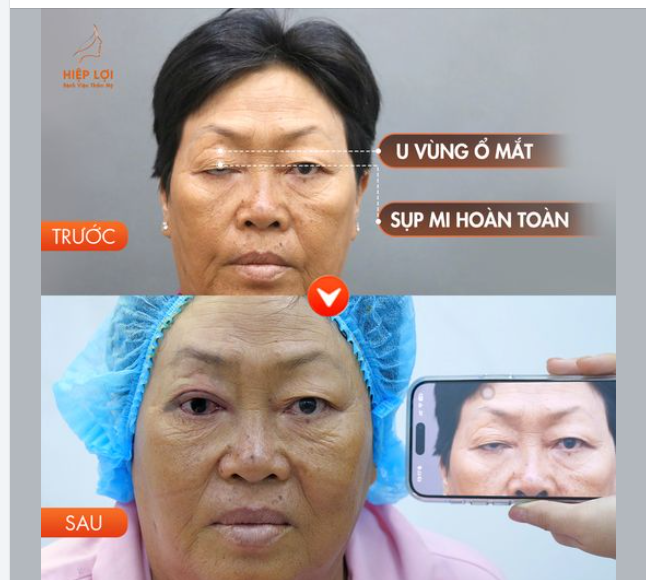 "Giải cứu" ca SỤP MI MẮT "nặng" tại BVTM Hiệp Lợi