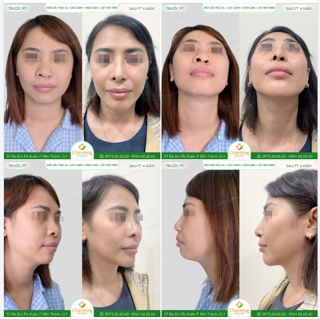 Nhìn những hình ảnh trước và sau phẫu thuật của nàng, phải nói là kết quả thật sự khác biệt.