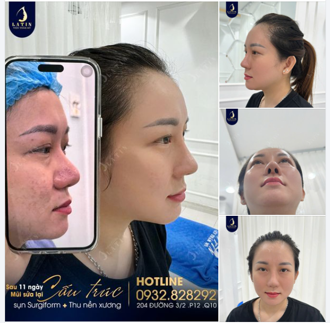 Tái khám sau 11 ngày sửa mũi