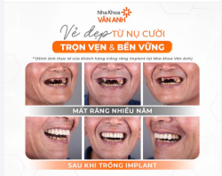 RĂNG IMPLANT: HƠN CẢ MỘT NỤ CƯỜI BỀ NGOÀI – LÀ CHẤT LƯỢNG SỐNG MỚI!