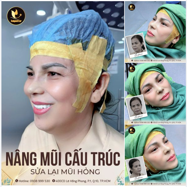 60 PHÚT NÂNG MŨI CẤU TRÚC - XÓA SỔ MŨI HỎNG