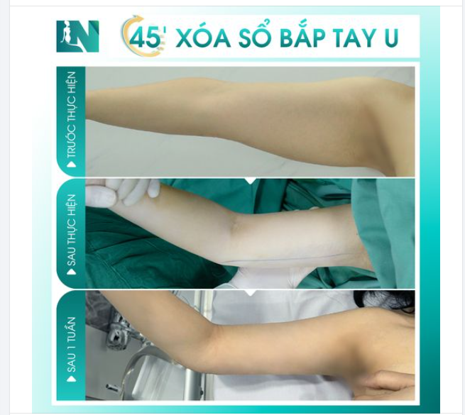 ĐÁNH TAN MỠ BẮP TAY – TẠM BIỆT TỰ TI