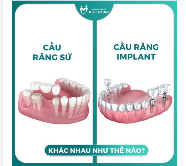 CẦU RĂNG SỨ VÀ CẦU RĂNG TRÊN IMPLANT KHÁC NHAU NHƯ THẾ NÀO?