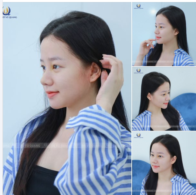 Minh chứng cho nâng mũi 3 ngày phục hồi - 7 ngày đẹp tự nhiên đây ạ!