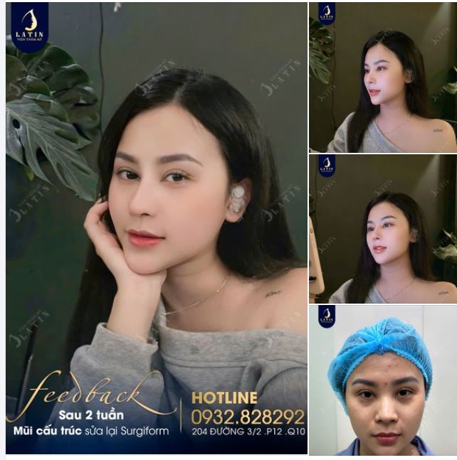 Nâng mũi sau 2 tuần đã đẹp chưa?