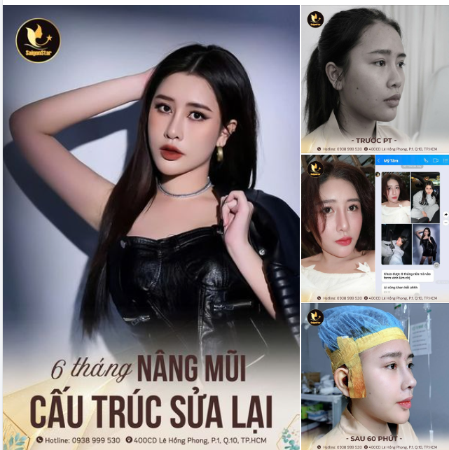 Cuối tuần, Bác sĩ Hoạt xin phép thả nhẹ một chiếc feedback về dáng mũi CẤU TRÚC SỬA LẠI siêu xinh để chị em có thêm động lực đi làm đẹp nha!