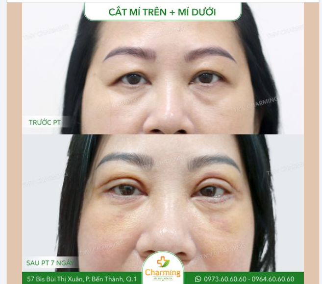 Sau khi thực hiện cắt mí trên và mí dưới, có thể thấy rõ sự thay đổi tích cực trên gương mặt của nàng.