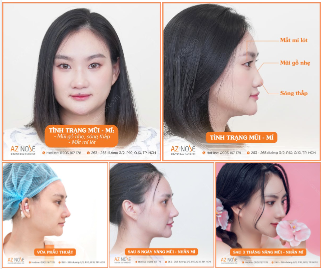 Khắc phục mũi thấp, gồ - mắt mí lót cho khách hàng ở Lâm Đồng