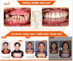 4 ĐIỀU " KHÁC BIỆT" KHI KHÁCH HÀNG TRỒNG RĂNG IMPLANT TẠI NHA KHOA VÂN ANH.