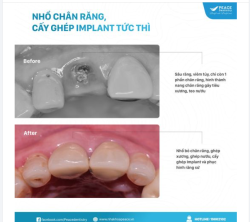 CA LÂM SÀNG IMPLANT VỚI KẾT QUẢ SAU ĐIỀU TRỊ TUYỆT VỜI: