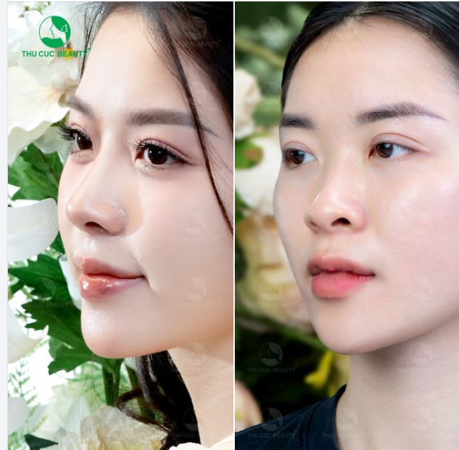 Một gương mặt sau nâng mũi TC bạn có nhận ra không?