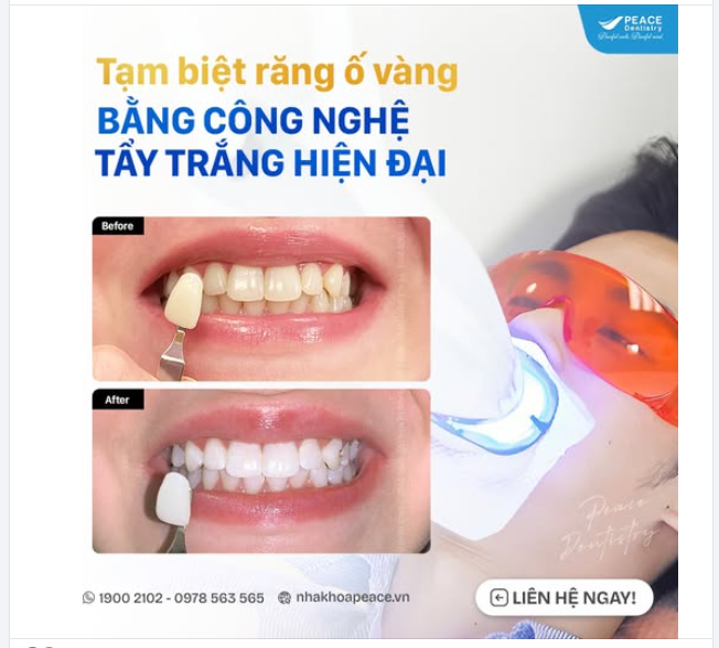 TẠM BIỆT RĂNG Ố VÀNG VỚI CÔNG NGHỆ TẨY TRẮNG RĂNG HIỆN ĐẠI TẠI PEACE DENTISTRY