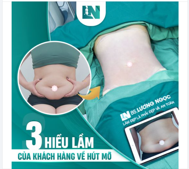 3 HIỂU LẦM CỦA KHÁCH HÀNG VỀ PHƯƠNG PHÁP HÚT MỠ