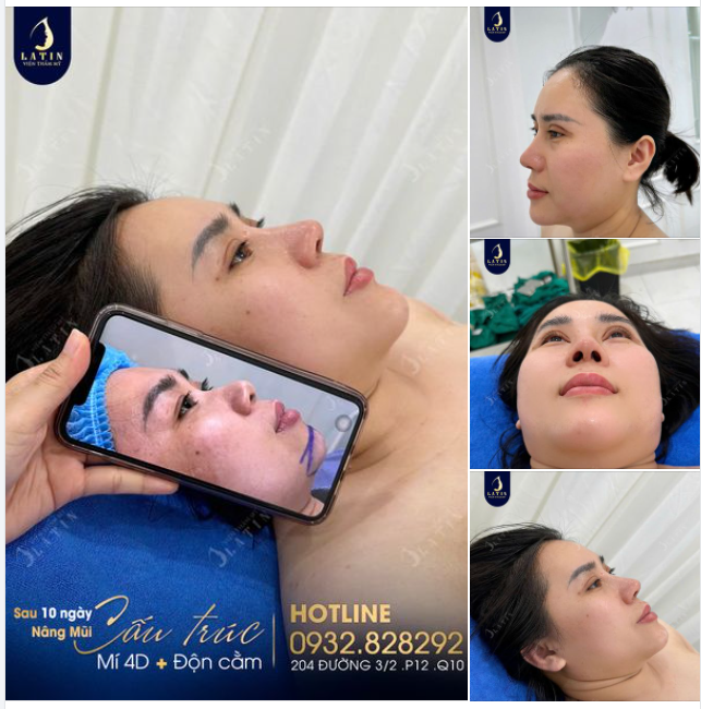 Khách hàng Việt kiều tái khám sau 10 ngày thực hiện Combo Full face: