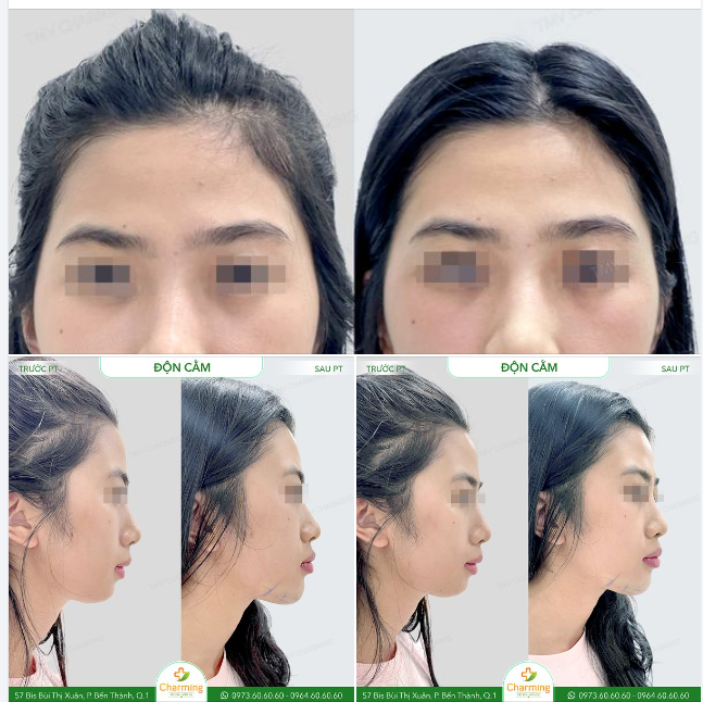 Nhìn nàng khách sau khi độn cằm mà phải nói là khác hẳn luôn nha! Trước phẫu thuật thì cằm hơi ngắn, gương mặt nhìn chưa được sắc sảo lắm, có cảm giác hơi thiếu điểm nhấn.
