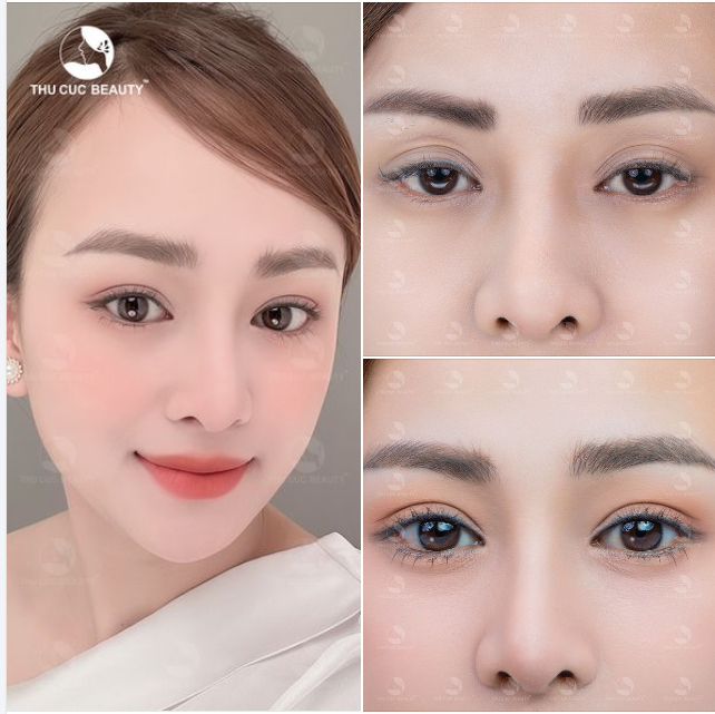 Không còn đôi mắt đa nếp mí, đẹp rõ nét ngay sau làm