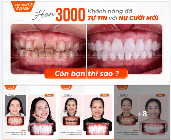 3 Lý Do Các "Chị Đẹp" Tin Tưởng Chọn Chúng Tôi Để Phục Hình Răng Sứ Tại Bắc Ninh