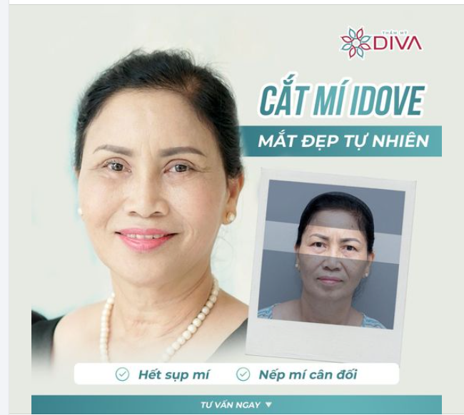 CẢI THIỆN TÌNH TRẠNG MẮT MỘT MÍ, SỤP MÍ CHE CHẮN TẦM NHÌN Ở NGƯỜI LỚN TUỔI BẰNG PP C.ẮT MÍ