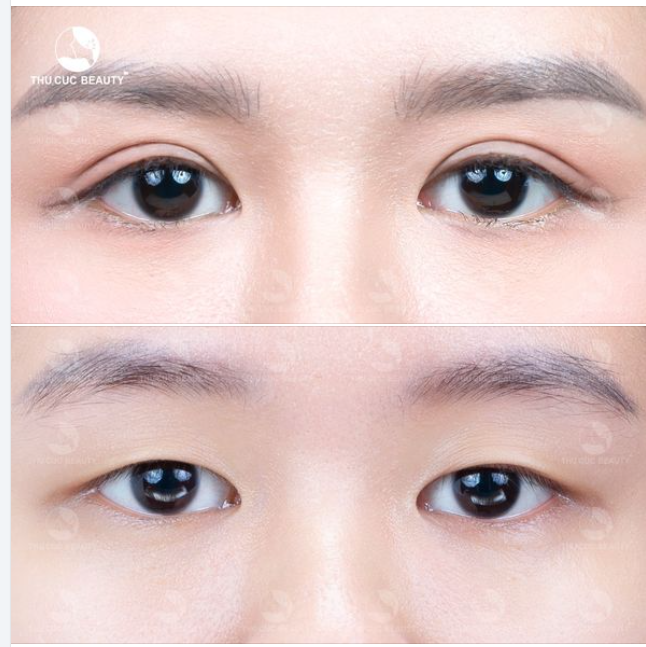 Nếp mí mềm mại, sắc nét chỉ sau 1 lần cắt mí