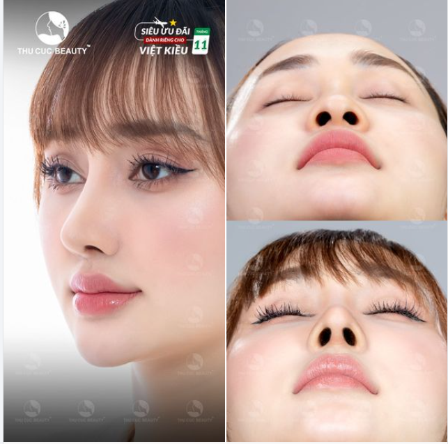 Tặng đến 5 chỉ vàng dành cho Việt Kiều muốn khắc phục sống mũi thấp/gồ/hỏng