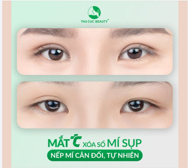 Không còn lo lắng mí mắt mất cân đối, gương mặt không có điểm nhấn