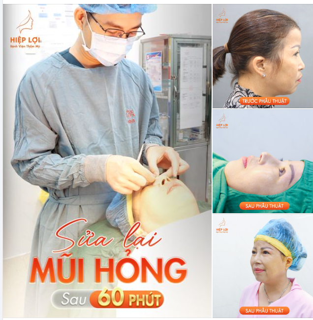 CA MŨI HỎNG sửa lại lần 2 cho chị khách hàng