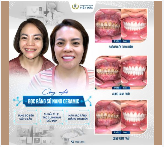 NGẠI GIAO TIẾP VÌ HÀM RĂNG XỈN MÀU VÀ KẾT QUẢ NGOÀI MONG ĐỢI KHI ĐẾN NKQT VIỆT ĐỨC