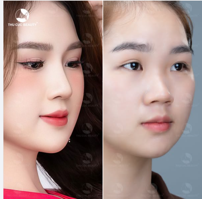 Xinh như hotgirl sau nâng mũi