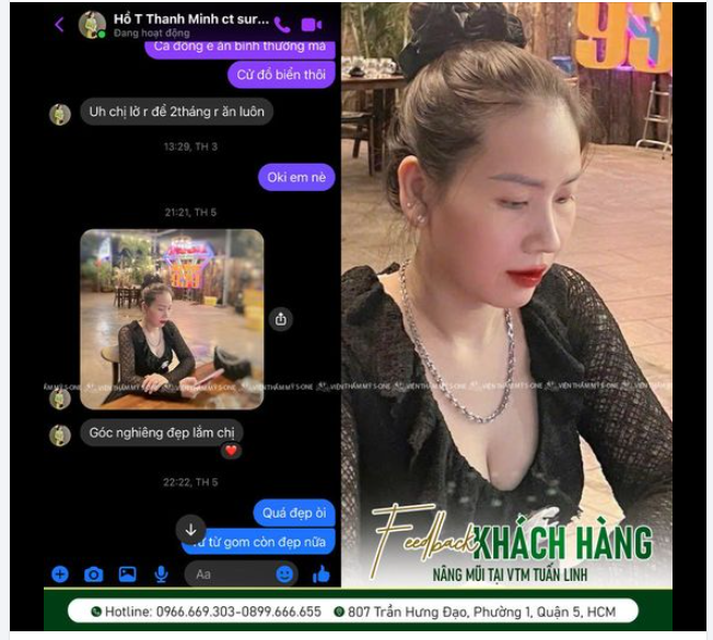 Feedback khách hàng. Mũi cấu trúc Surgiform sau 1 tháng đẹp chuẩn form!!