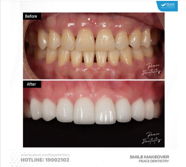 5 SỰ KHÁC BIỆT KHI LÀM VENEER TẠI PEACE DENTISTRY
