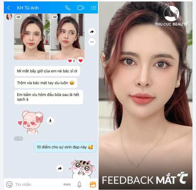 Feedback cắt mí chân thực của KH Tú Anh tại Thu Cúc