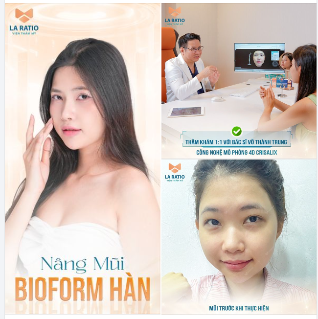 Nâng mũi BIOFORM - Phương pháp hiệu quả cho khách hàng muốn dáng mũi bay