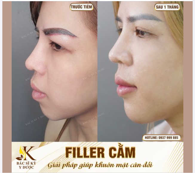 Tiêm Filler cằm PHONG THỦY Có ngay cằm chuẩn tỷ lệ vàng