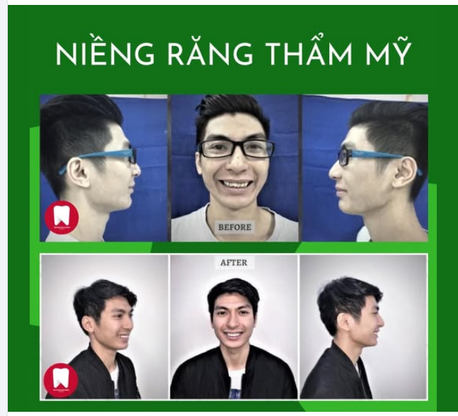 TỰ TI VỀ HÀM RĂNG KHẤP KHỂNH, KHÔNG ĐỀU