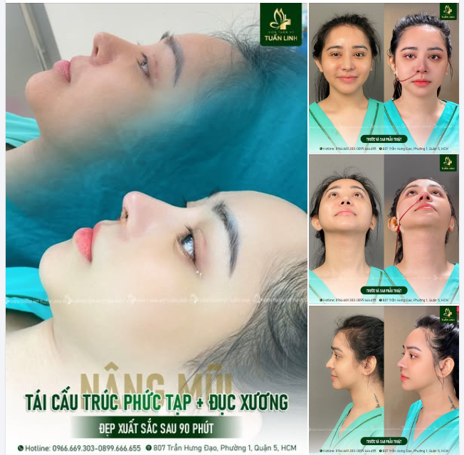 Khách hàng cực kỳ hài lòng và hạnh phúc khi sở hữu được dáng mũi đẹp theo đúng mong muốn, cực kỳ hợp mặt và xinh đẹp hơn rất nhiều.