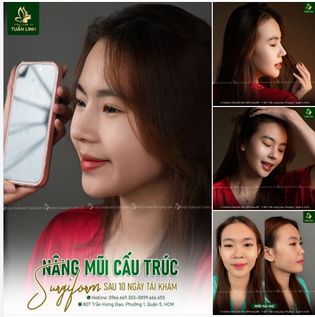 Dáng mũi ''cực phẩm'' sau 10 ngày tái khám!!