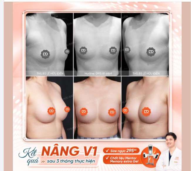 KẾT QUẢ NÂNG V1 SAU 3 THÁNG THỰC HIỆN