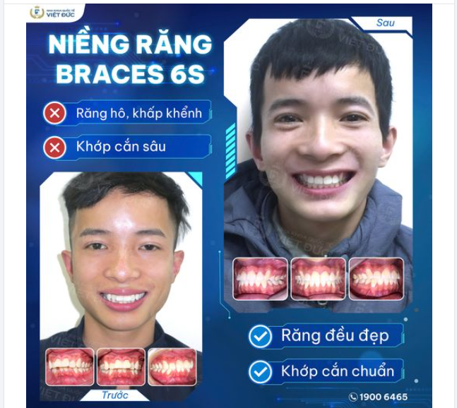 NIỀNG RĂNG, BẠN ĐẸP LÊN TỪNG NGÀY