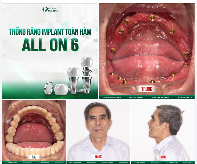 TRỒNG RĂNG TOÀN HÀM - TỰ TIN NỤ CƯỜI, THỎA MÃN ĂN NHAI