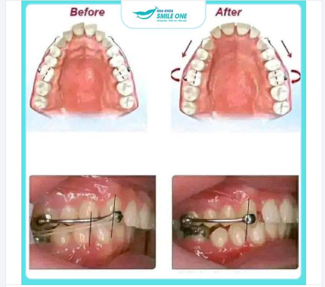 PHẢI NHỔ RĂNG KHI NIỀNG RĂNG CÓ ĐANG LÀ NỖI ÁM ẢNH CỦA BẠN?