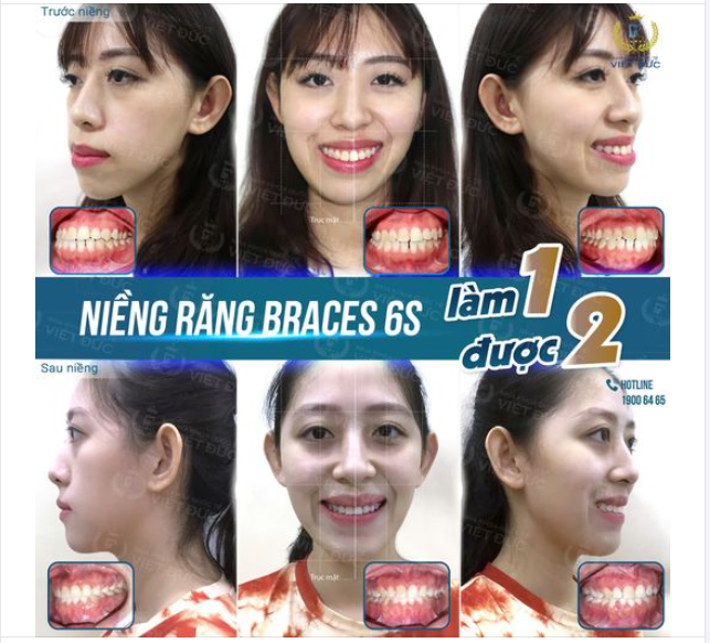 HẾT LỆCH MẶT NHỜ NIỀNG RĂNG, KHÔNG CẦN PHẪU THUẬT MỪNG NGÀY THÁO NIỀNG: KHÁCH HÀNG NGUYỄN NGỌC TRÂM