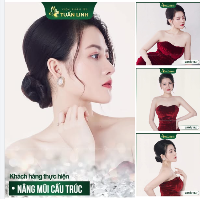 NÂNG MŨI CẤU TRÚC – VẺ ĐẸP TỰ NHIÊN, TINH TẾ
