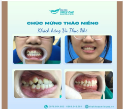 HÀNH TRÌNH NIỀNG RĂNG CỦA BẠN ĐẾN ĐÂU RỒI?