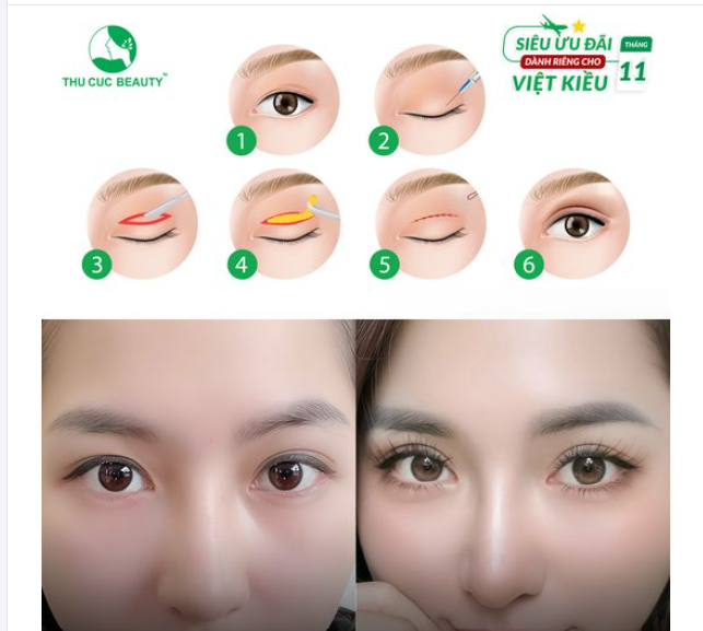 Tặng ngay đến 5 chỉ vàng 9999 dành cho Việt Kiều muốn loại bỏ mí sụp