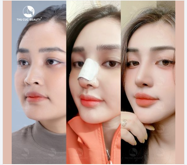  Hành trình thay đổi dáng mũi chỉ sau 5 ngày vào form của chị khách