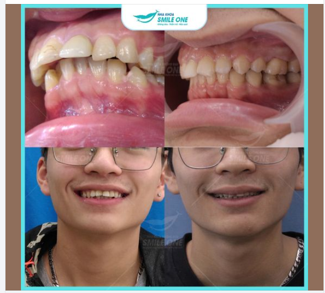 RĂNG HÔ CÓ ĐANG CẢN TRỞ SỰ NGHIỆP CỦA BẠN?