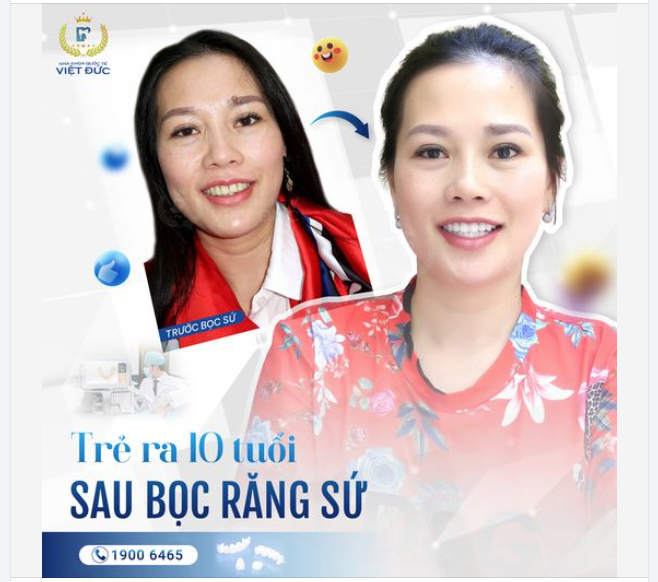 TRẺ RA 10 TUỔI SAU BỌC RĂNG SỨ DR. MẬU
