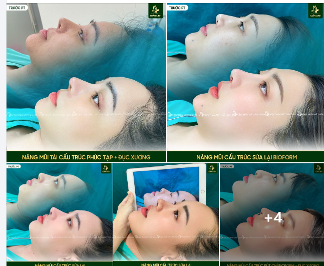 NÂNG MŨI TẠI TUẤN LINH - MŨI ĐẸP NGAY SAU PHẪU THUẬT LÀ CÓ THẬT!!